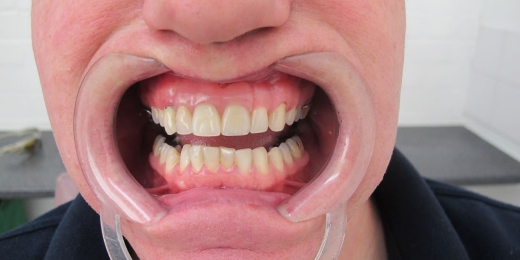 Flexible Dentures Front Teeth Kansas City MO 64160